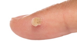 Verruga - doença da pele com a qual eficaz no combate Skincell Pro