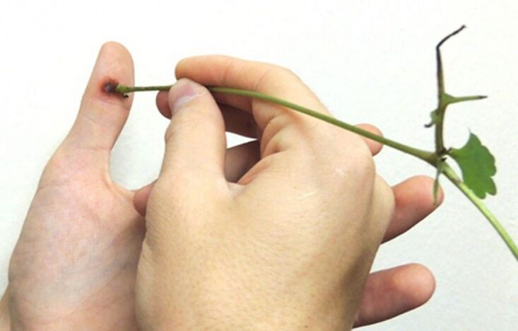remoção de uma verruga em um dedo com suco de erva celidônia